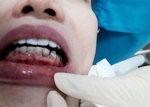 Răng sứ chất lượng kém