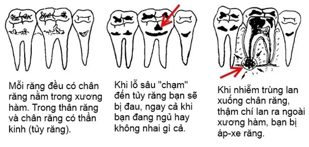 Những dấu hiệu nhận biết răng bị sâu nặng