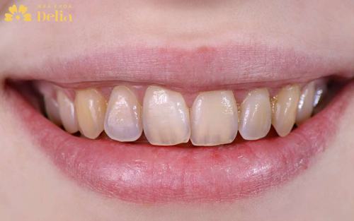 Răng bị xỉn màu là răng bị như thế nào