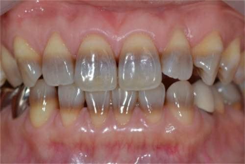 Răng bị xỉn màu do dùng kháng sinh 