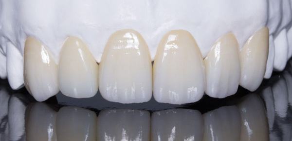 Răng sứ Cercon HT khả năng chịu lực nhai tốt