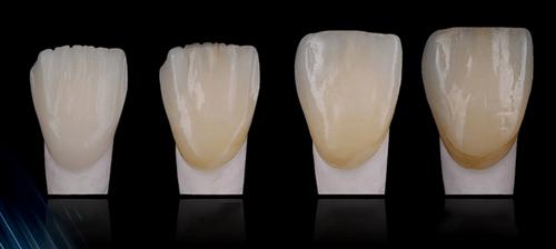 tính thẩm mỹ cao của răng sứ lisi