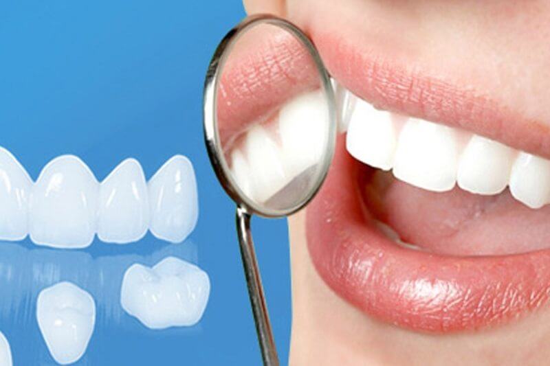 có nên bọc răng sứ nacera? những ai nên bọc răng sứ nacera
