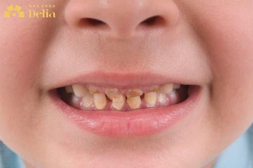 Răng trẻ em bị xỉn đen 