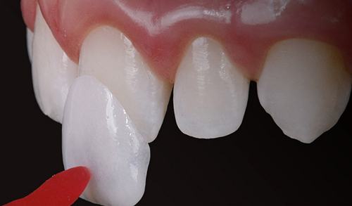 dán sứ veneer