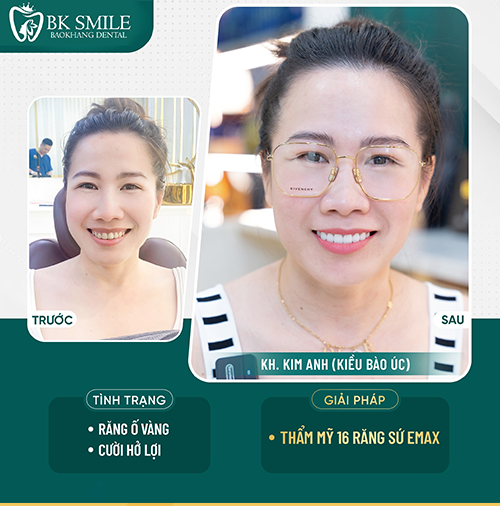 Khách hàng Thùy Trâm bọc sứ 22 răng Lava Plus