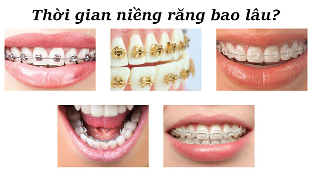 thời gian niềng răng bao lâu