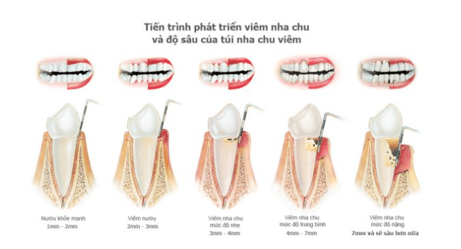 tiến trình phát triển viêm nha chu