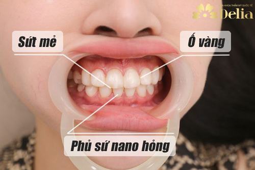 Tình trạng răng trước đây của khách hàng Cẩm Linh