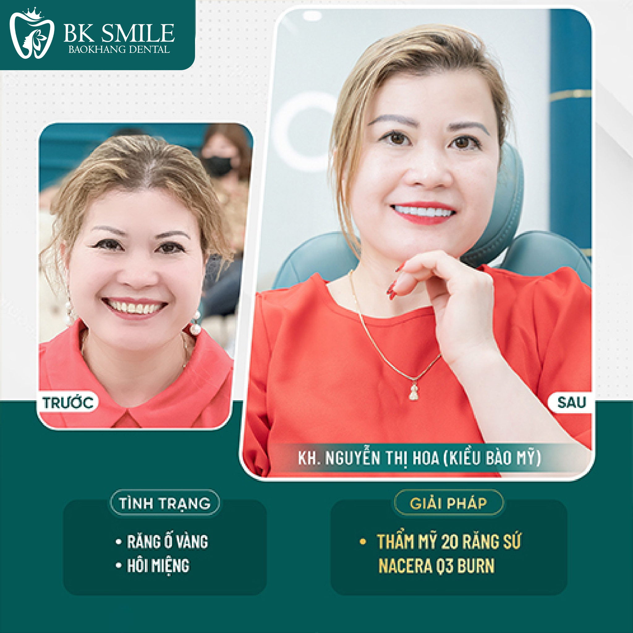 bọc sứ ht smile khắc phục răng thưa
