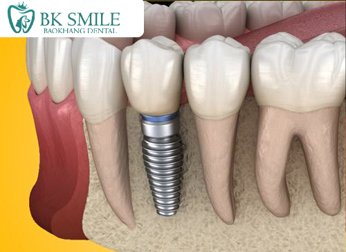 trồng răng implant là gì