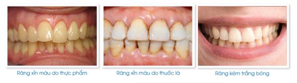 đối tượng áp dụng tẩy trắng răng 