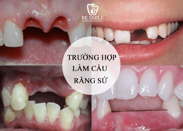 trường hợp làm cầu sứ