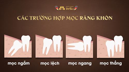 các trường hợp răng khôn mọc