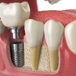 tuổi thọ của trụ implant 