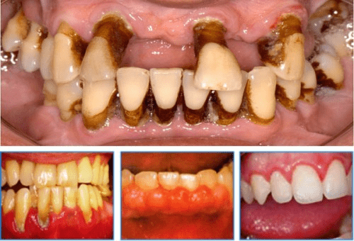 Tác hại của viêm nha chu đối với hàm răng