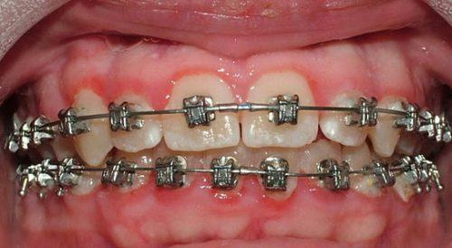 Viêm nướu khi niềng răng