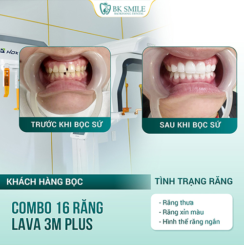 Streamer Duy Còm Lucky Man trồng răng Implant phục hình răng mất kết hợp bọc sứ 16 răng HT Smile 